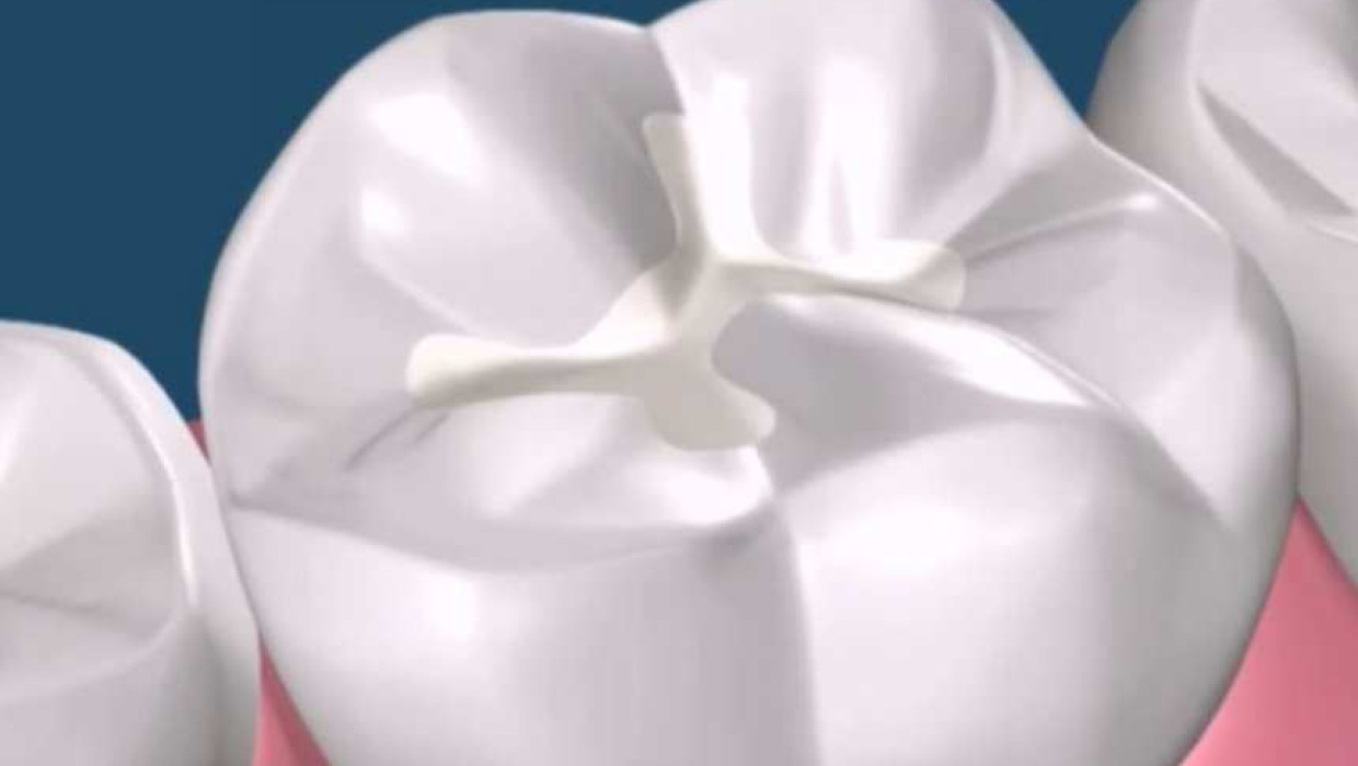 imagen 3d de un diente