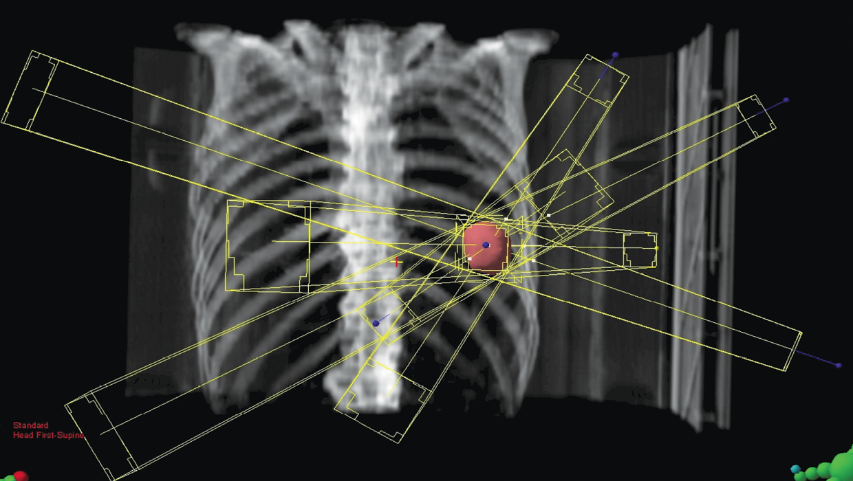 radiografia 3d de unos pulmones