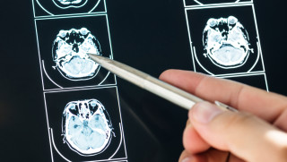 Resultado exploración del cerebro
