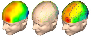 neuroimagen