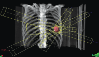 radiografia 3d de unos pulmones