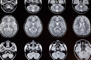 Resonancia magnética del cerebro